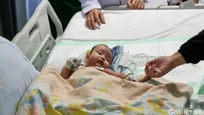 Satu Bayi Kembar Siam Meninggal