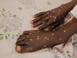 Mpox Clade I Tersebar ke AS, Pasien Baru Saja Kembali dari Afrika Timur