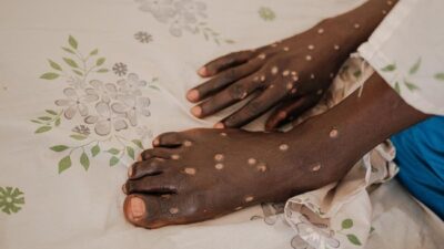 Mpox Clade I Tersebar ke AS