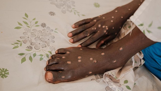 Mpox Clade I Tersebar ke AS