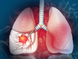 Gejala Kanker Paru yang Sering Terlewat, Batuk Berkepanjangan