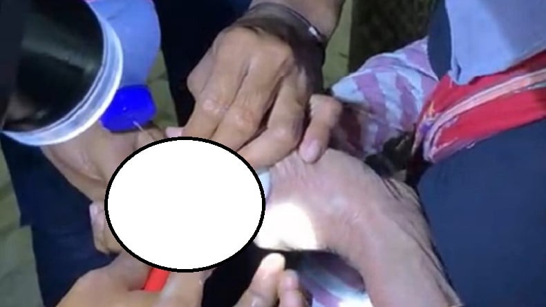 Cincin Terjebak di Jari Balita