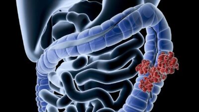 Ternyata banyak anak muda Indonesia menderita kanker kolon, kenali gejalanya sejak awal.