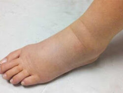 Pasbar Lanjutkan Pengawasan Penyakit Filariasis Pasca Bebas Penularan